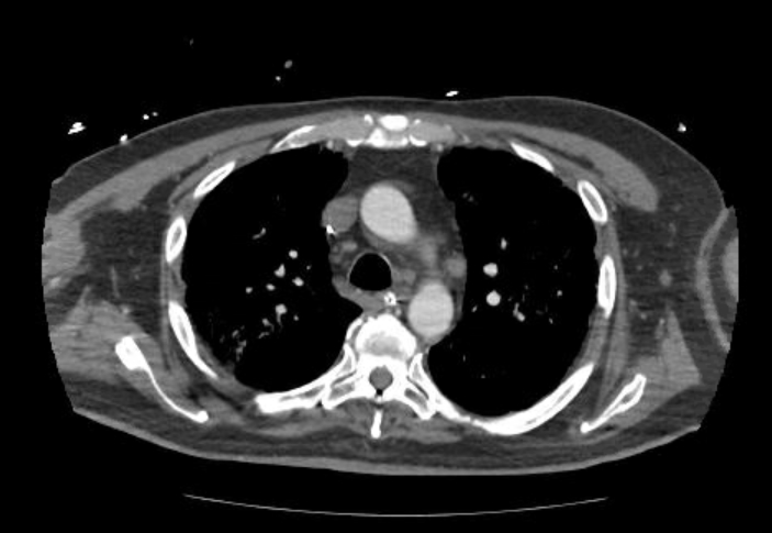 Acute cor pulmonale (ultrasound) (Radiopaedia 83508-98818 Axial C+ CTPA 23).jpg