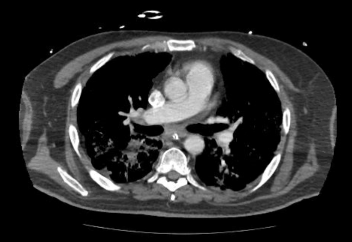 Acute cor pulmonale (ultrasound) (Radiopaedia 83508-98818 Axial C+ CTPA 35).jpg
