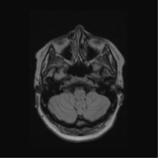 Acute disseminated encephalomyelitis (ADEM) (Radiopaedia 38073-40065 Axial FLAIR 10).png
