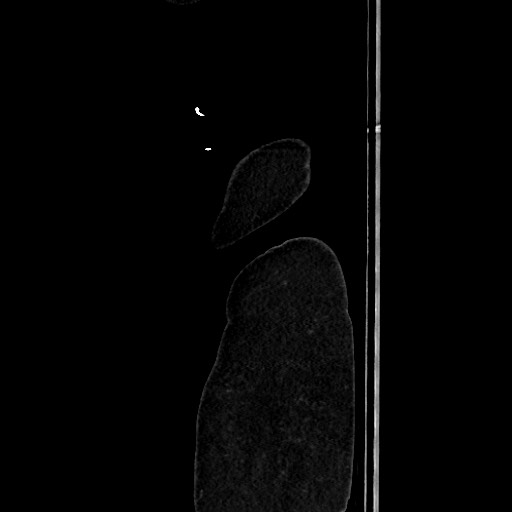 Acute diverticulitis - transverse colon (Radiopaedia 87063-103327 Sagittal C+ portal venous phase 228).jpg