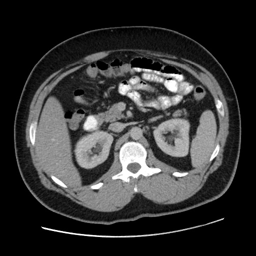 Acute diverticulitis with localized perforation (Radiopaedia 41296-44113 Axial C+ portal venous phase 33).jpg