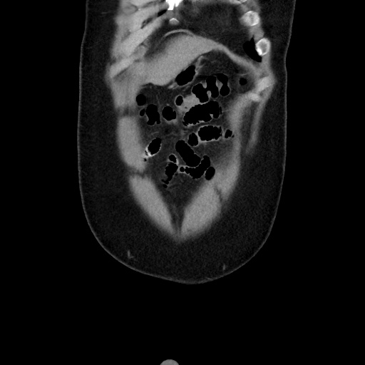 Acute diverticulitis with localized perforation (Radiopaedia 41296-44113 Coronal C+ portal venous phase 14).jpg