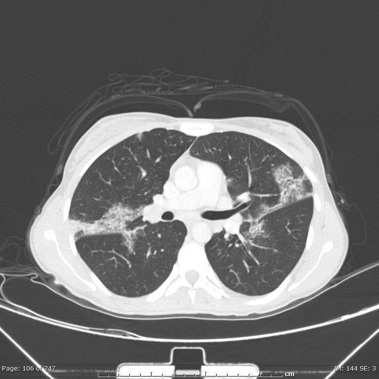 Acute eosinophilic pneumonia (Radiopaedia 48211-53073 Axial lung window 38).jpg