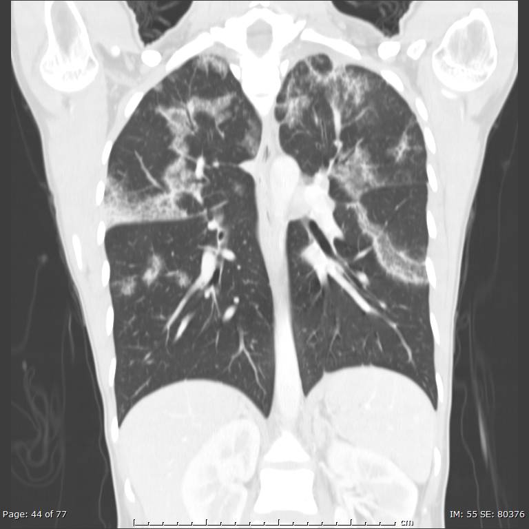 Acute eosinophilic pneumonia (Radiopaedia 48211-53073 Coronal lung window 29).jpg