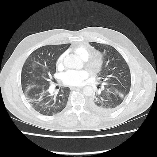 File:Acute epicardial fat necrosis (Radiopaedia 42327-45440 Axial lung window 33).jpg