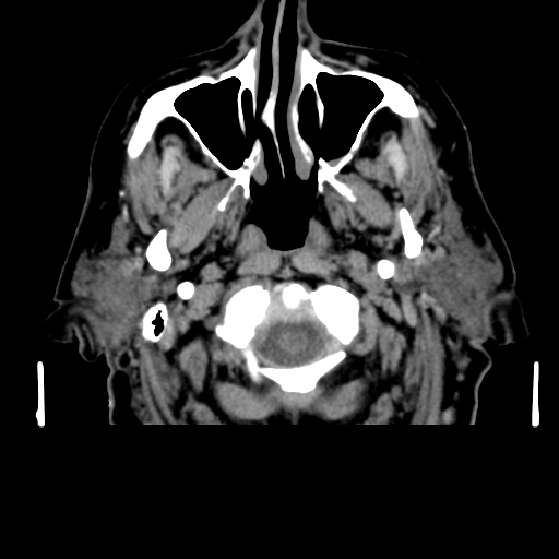 Acute hemorrhagic stroke (Radiopaedia 17507-17223 Axial non-contrast 4).jpg