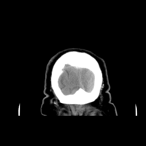 Acute hemorrhagic stroke (Radiopaedia 17507-17223 Coronal non-contrast 56).jpg