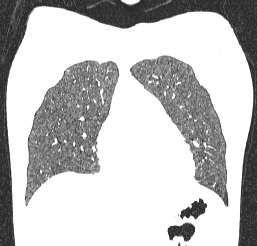 Acute hypersensitivity pneumonitis (Radiopaedia 85293-100870 Coronal lung window 30).jpg