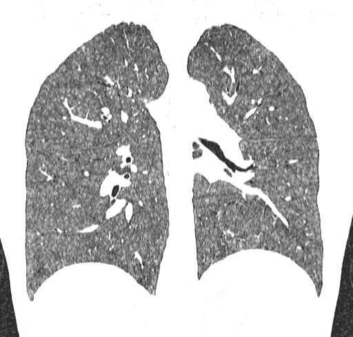 Acute hypersensitivity pneumonitis (Radiopaedia 85293-100870 Coronal lung window 81).jpg