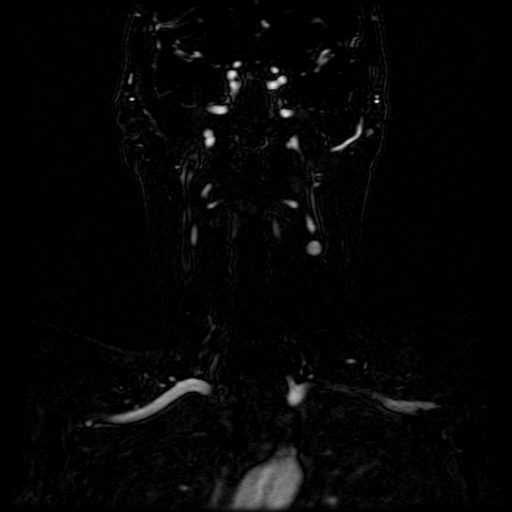Acute internal carotid artery dissection (Radiopaedia 53541-59632 Coronal MRA 44).jpg