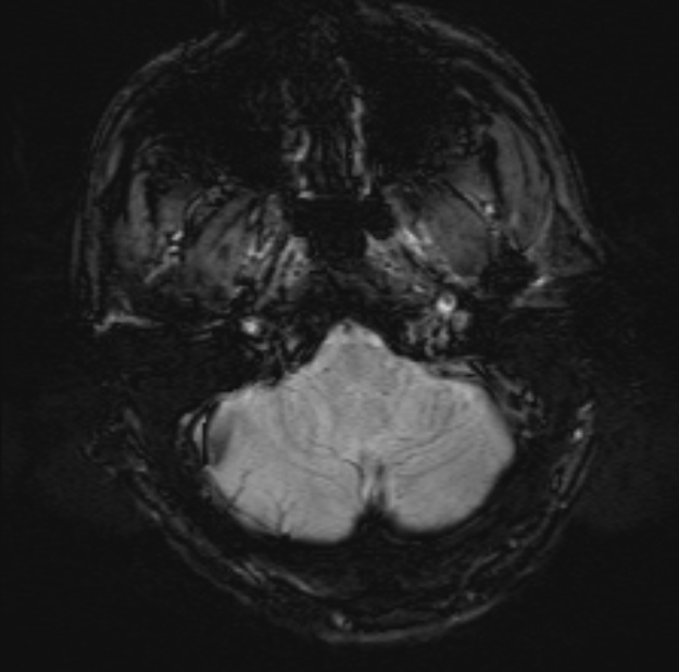 Acute ischemic stroke - posterior circulation territory (Radiopaedia 77670-89880 Axial SWI 9).jpg