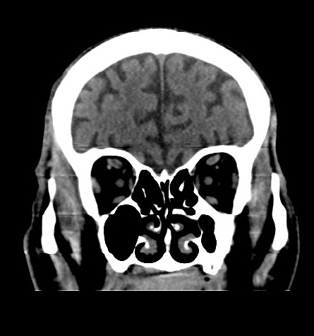 Acute left anterior cerebral artery territory infarction (Radiopaedia 51785-57578 Coronal non-contrast 14).jpg
