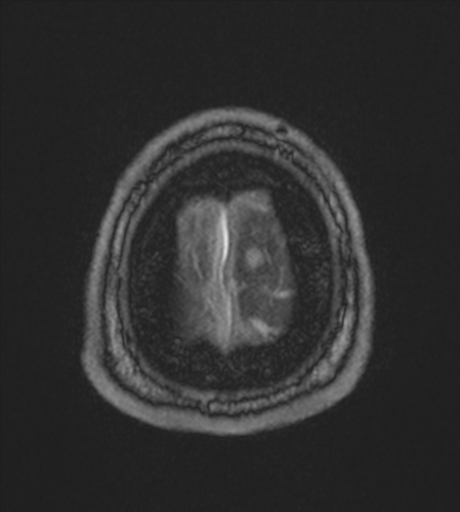 Acute left middle cerebral artery territory infarct with clot retrieval (Radiopaedia 47732-52433 Axial MRA 66).png