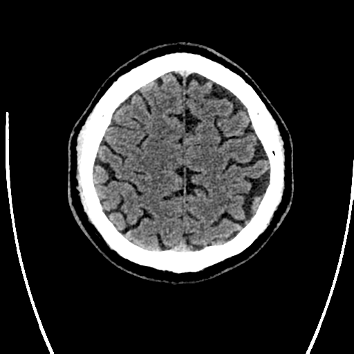 Acute left middle cerebral artery territory ischemic stroke (Radiopaedia 35688-37223 Axial non-contrast 68).png