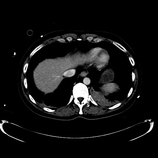 File:Acute myocardial infarction in CT (Radiopaedia 39947-42457 Axial C+ portal venous phase 16).jpg