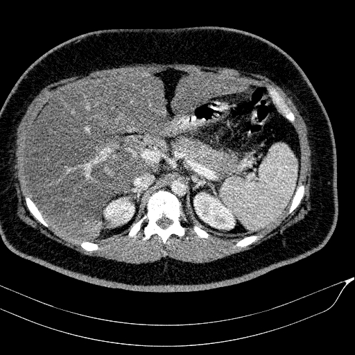 Acute on chronic pancreatitis (Radiopaedia 80902-94423 Axial C+ portal venous phase 46).jpg