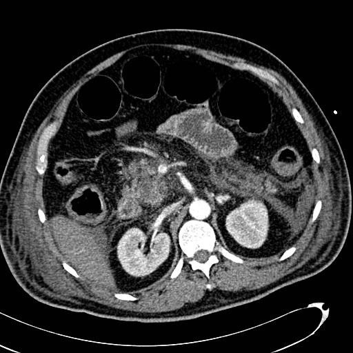 File:Acute pancreatic necrosis (Radiopaedia 13560-13486 Axial C+ portal venous phase 59).jpg