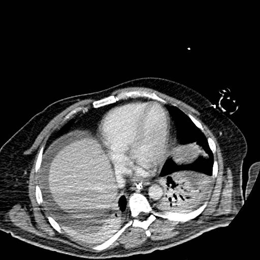 File:Acute pancreatic necrosis (Radiopaedia 13560-18501 Axial C+ portal venous phase 1).jpg