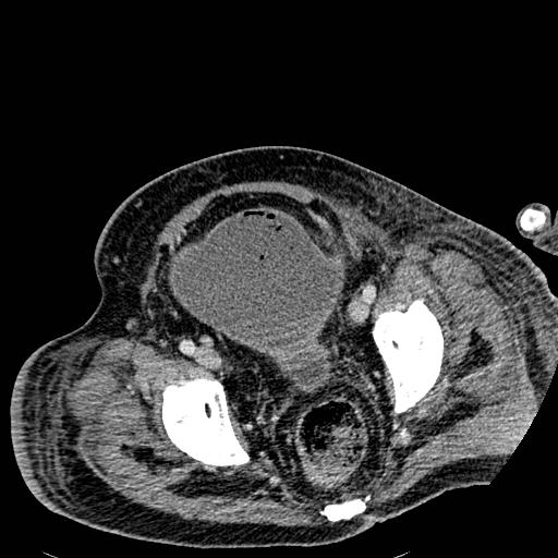 Acute pancreatic necrosis (Radiopaedia 13560-18501 Axial C+ portal venous phase 133).jpg