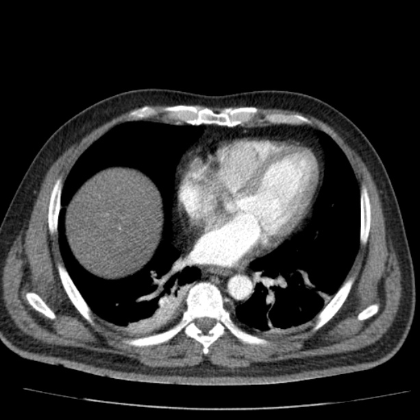 Acute pancreatitis (Radiopaedia 26663-26813 Axial C+ arterial phase 9).jpg