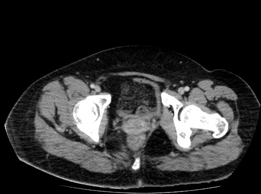 Acute pancreatitis (Radiopaedia 69236-79012 Axial C+ portal venous phase 86).jpg