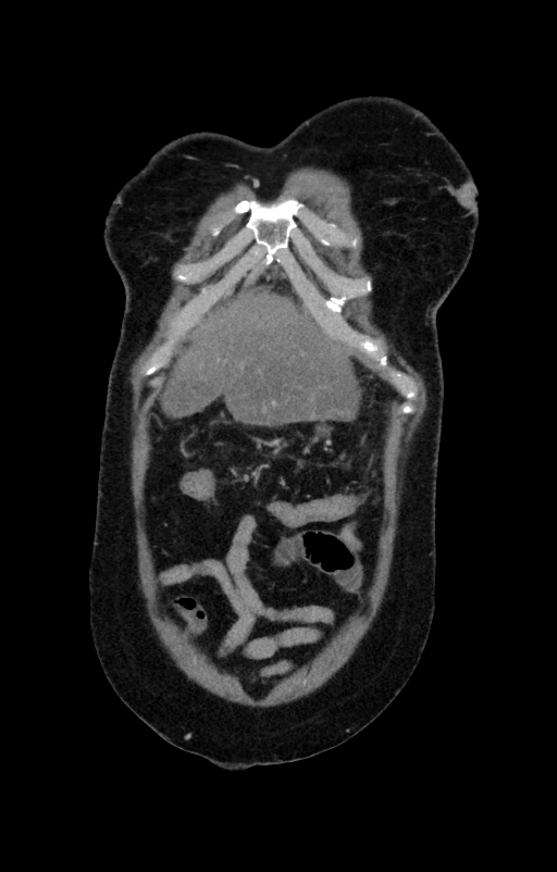 Acute pancreatitis (Radiopaedia 80007-93285 Coronal C+ portal venous phase 13).jpg