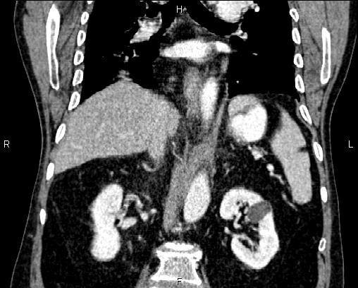 Acute pancreatitis (Radiopaedia 85146-100701 Coronal C+ portal venous phase 47).jpg