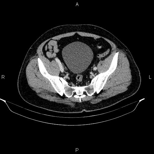 Acute pancreatitis (Radiopaedia 85390-101010 Axial C+ portal venous phase 88).jpg
