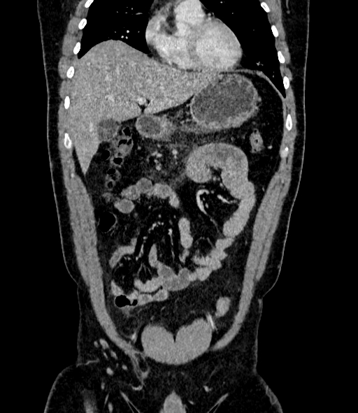 Acute pancreatitis (Radiopaedia 87428-103757 Coronal C+ portal venous phase 29).jpg