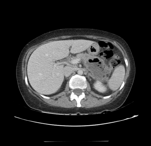 Acute pancreatitis - Balthazar E - post ERCP (Radiopaedia 27562-27772 Axial C+ portal venous phase 25).png
