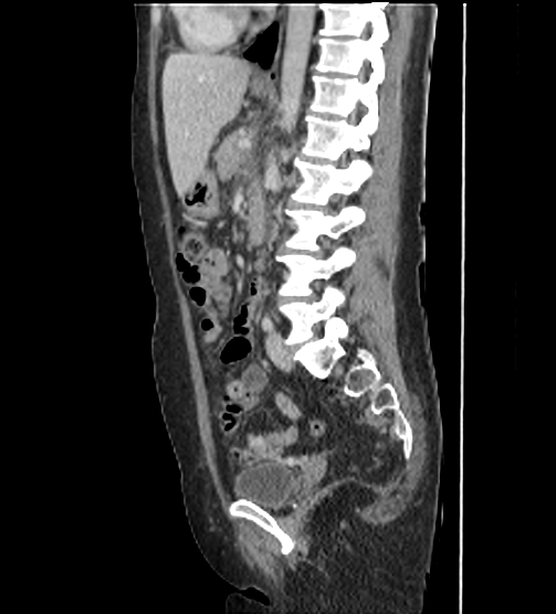 File:Acute pancreatitis - Balthazar E - post ERCP (Radiopaedia 27562-27772 Sagittal C+ portal venous phase 76).png