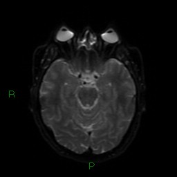 Acute posterior cerebral artery territory infarct (Radiopaedia 79329-92394 Axial DWI 39).jpg