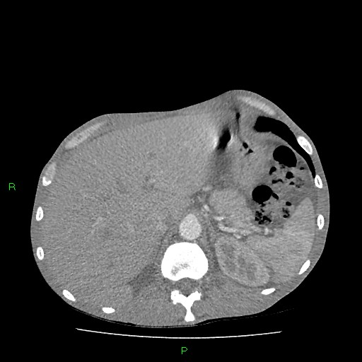 File:Acute right lung abscess (Radiopaedia 34806-36258 Axial C+ arterial phase 182).jpg