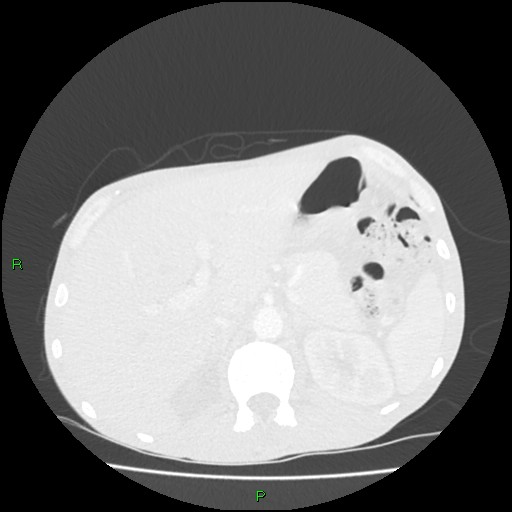 Acute right lung abscess (Radiopaedia 34806-36258 Axial lung window 189).jpg