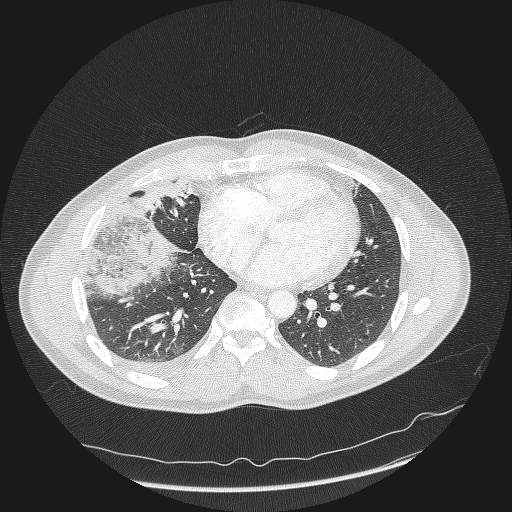 Acute segmental pulmonary emboli and pulmonary infarction (Radiopaedia 62264-70444 Axial lung window 123).jpg