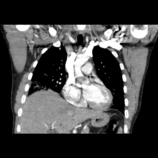 Acute segmental pulmonary emboli and pulmonary infarction (Radiopaedia 62264-70444 Coronal C+ CTPA 20).jpg