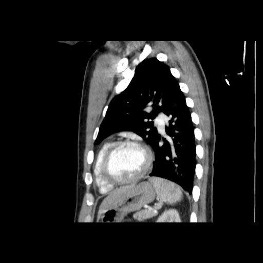 Acute segmental pulmonary emboli and pulmonary infarction (Radiopaedia 62264-70444 Sagittal C+ CTPA 47).jpg