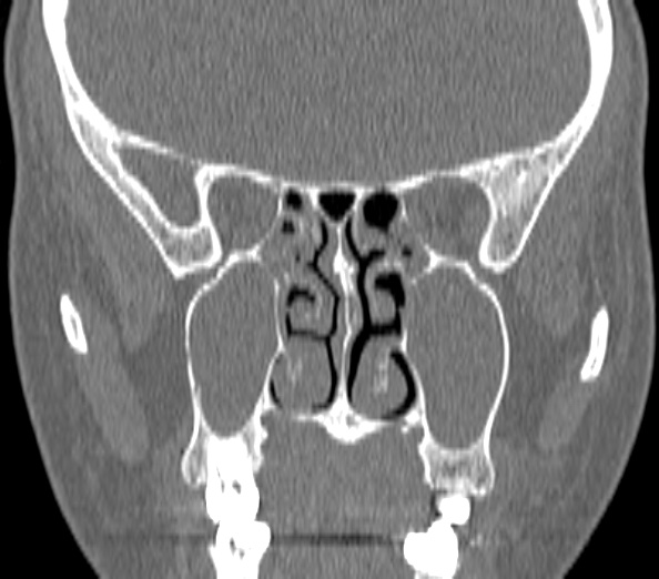 Acute sinusitis (Radiopaedia 40564-43158 Coronal bone window 26).jpg