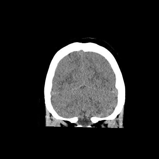 Acute subarachnoid hemorrhage and accessory anterior cerebral artery (Radiopaedia 69231-79008 Coronal non-contrast 59).jpg