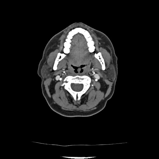 Acute subarachnoid hemorrhage and accessory anterior cerebral artery (Radiopaedia 69231-79009 Axial C+ arterial phase 63).jpg
