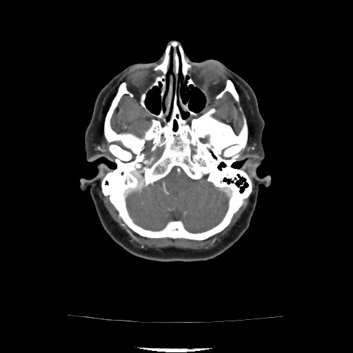 Acute subarachnoid hemorrhage and accessory anterior cerebral artery (Radiopaedia 69231-79009 Axial C+ arterial phase 80).jpg