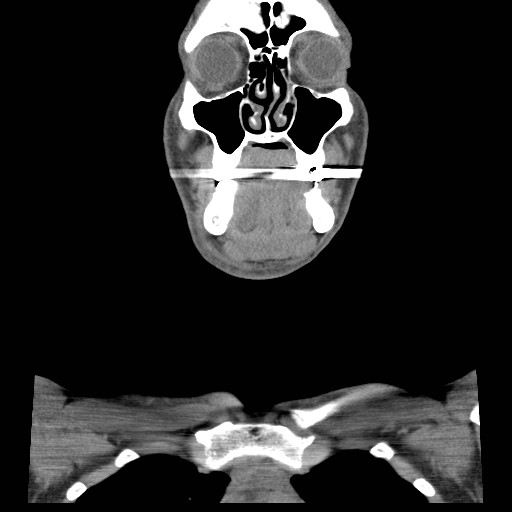 File:Acute submandibular sialadenitis secondary to ductal stone (Radiopaedia 27999-28267 Coronal C+ delayed 17).jpg