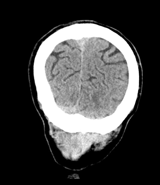 File:Acute superior cerebellar artery territory infarct (Radiopaedia 84104-99359 Coronal non-contrast 76).jpg