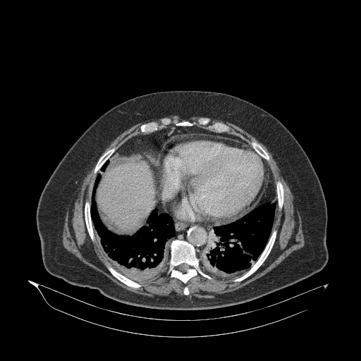 File:Acute superior mesenteric artery occlusion (Radiopaedia 51288-56960 Axial C+ portal venous phase 6).jpg