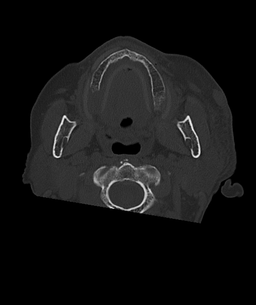 Acute traumatic subdural hematoma (Radiopaedia 82921-97257 Axial bone window 109).jpg