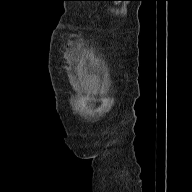 Acute tubular necrosis (Radiopaedia 28077-28334 Sagittal non-contrast 6).jpg