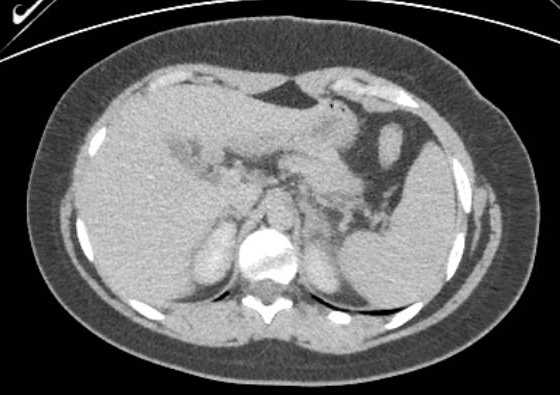 Acute unilateral nonhemorrhagic adrenal infarction (Radiopaedia 67560-76957 Axial renal excretory phase 24).jpg