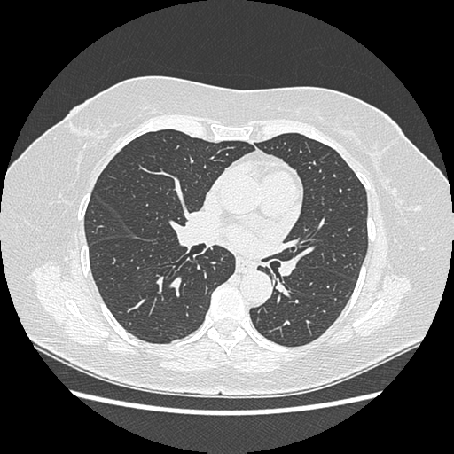Adenocarcinoma in situ of lung (Radiopaedia 38685-40829 B 114).png