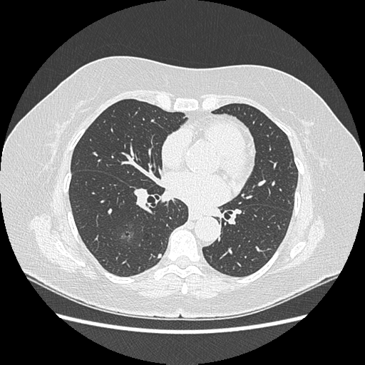 Adenocarcinoma in situ of lung (Radiopaedia 38685-40829 B 126).png