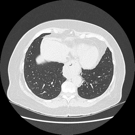 Adenocarcinoma in situ of lung (Radiopaedia 38685-40829 B 171).png